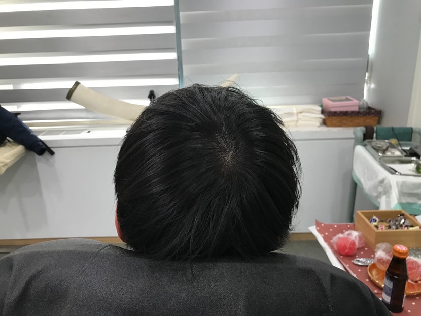 시술후 마른머리