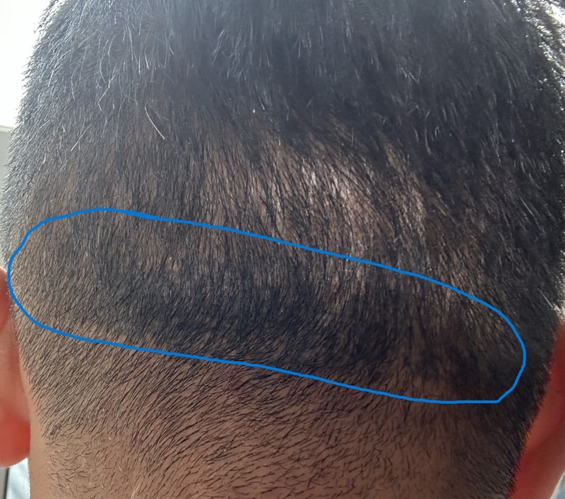 For those who want to do the back of their hair for 4 years after getting a scalp tattoo, please refer to [New Hair Gangnam]