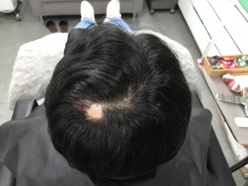 두피문신 후기