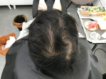 시술 전 
