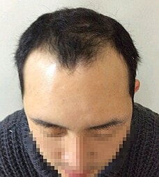 The first day of the Busan scalp tattoo. Awesome!
