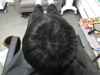 시술후