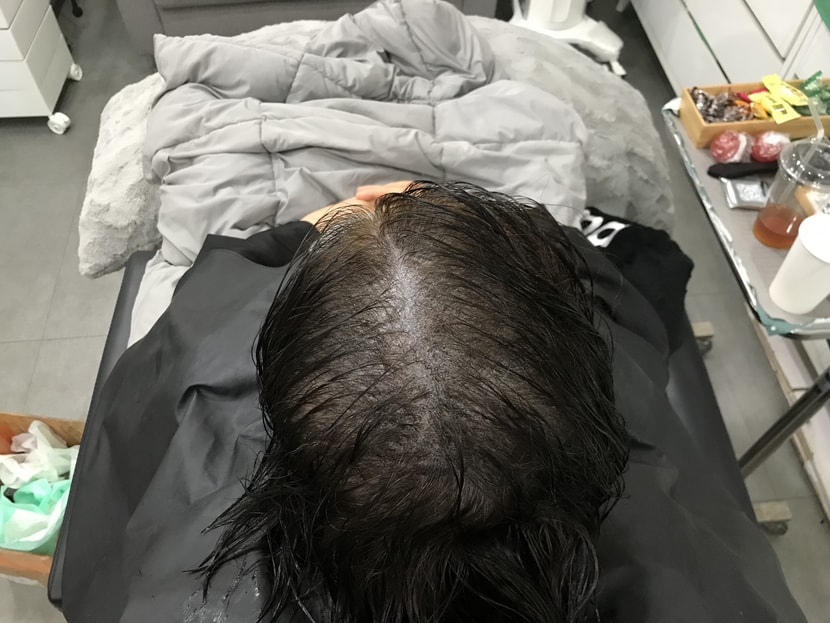 시술 후(젖은 머리 상태)