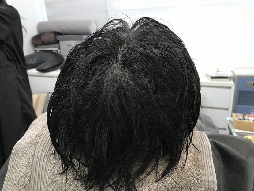 시술후