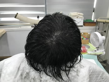 리터치후