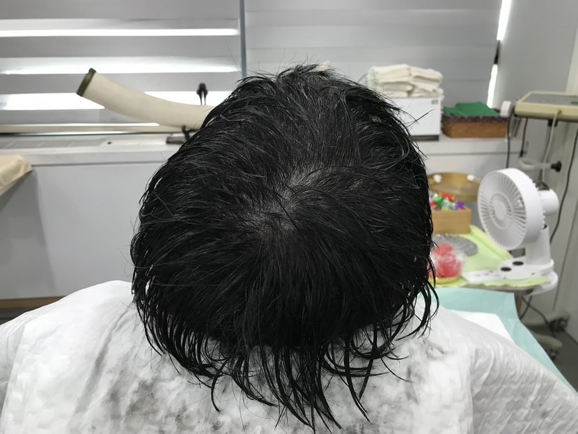 리터치후