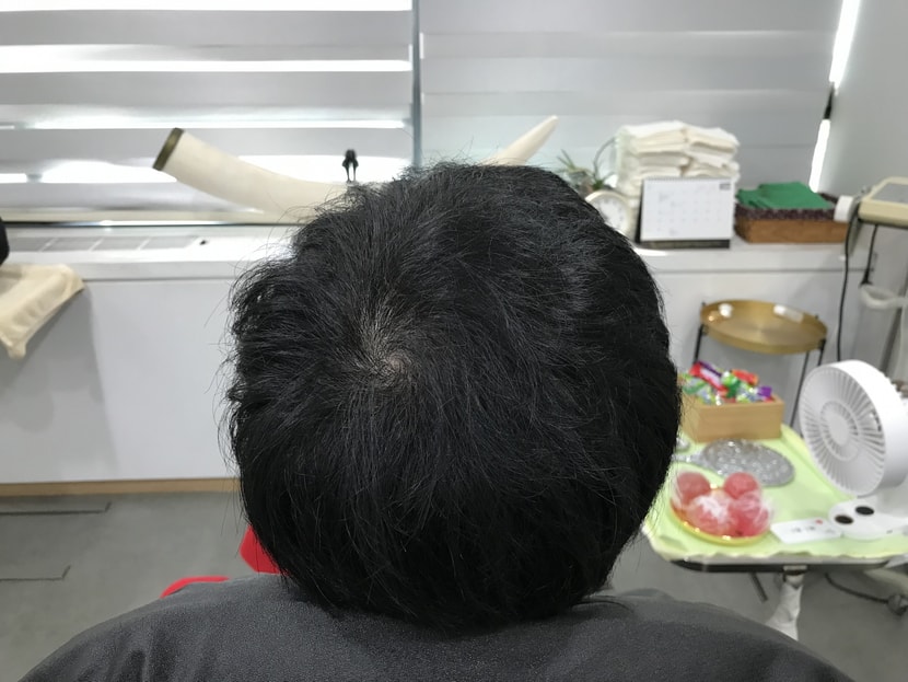 시술후