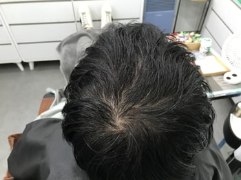 시술전