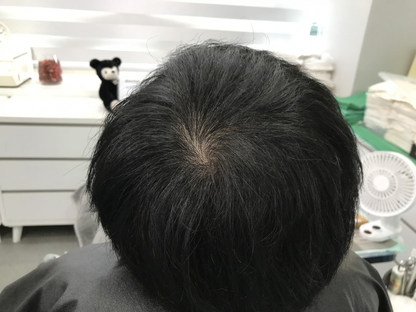 시술전 