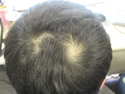 There is also a place in Incheon where scalp tattoos can be treated. Haha.