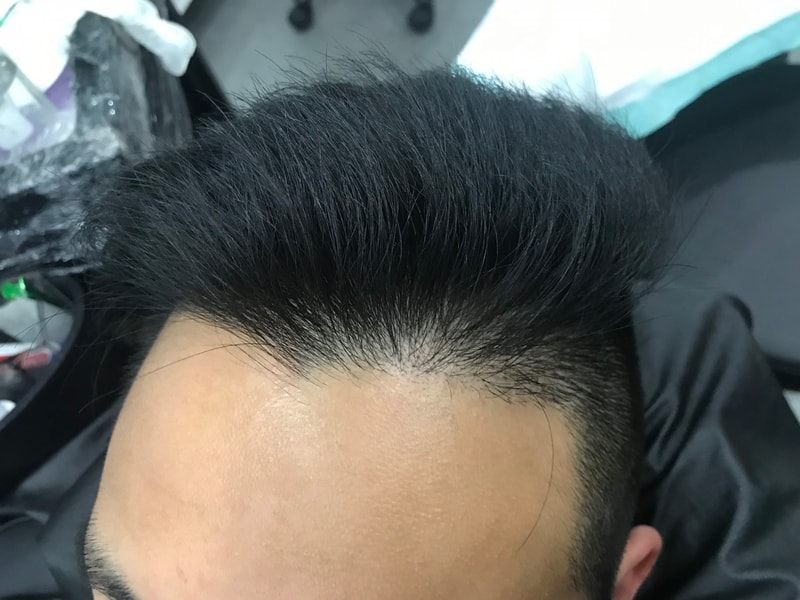 微圆点1次手术后期。
