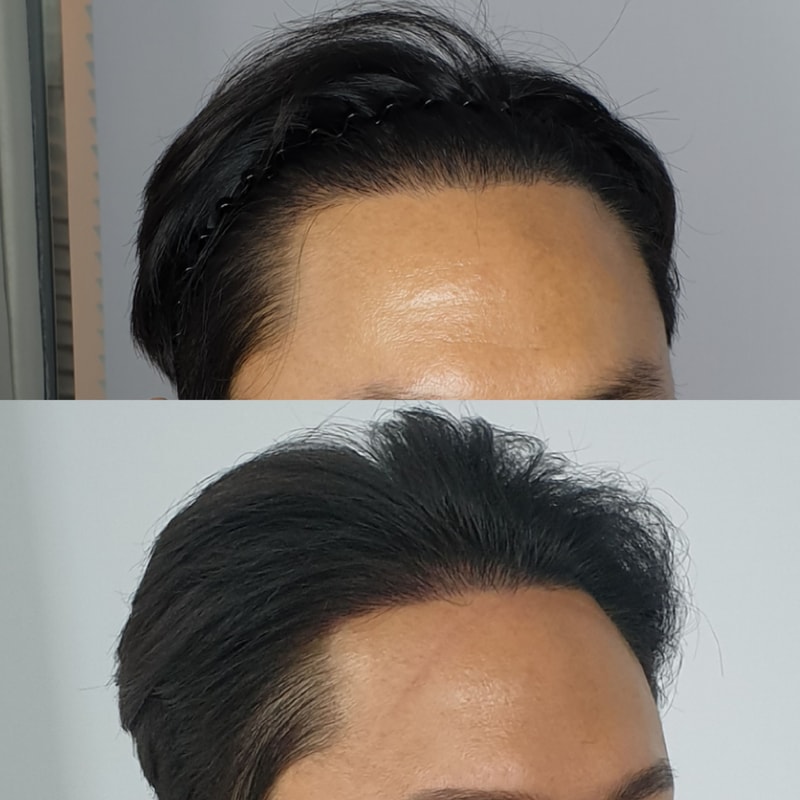 是发际线头皮纹身后记~