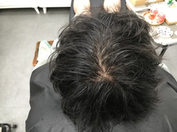 시술전 물 묻히고