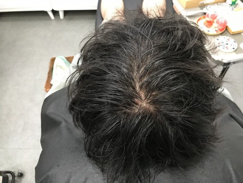 시술전 물 묻히고