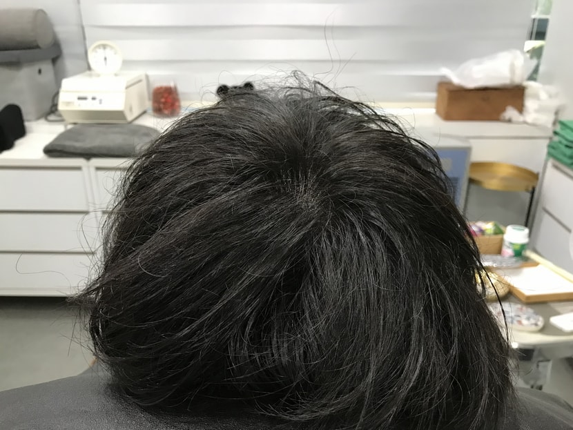 시술후 머리 말린후2
