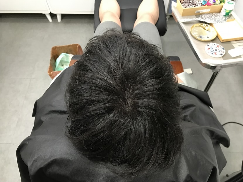시술후 머리 말린후