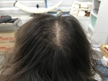 시술 전