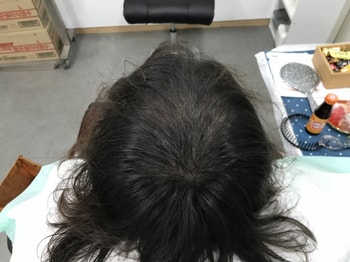 시술 후