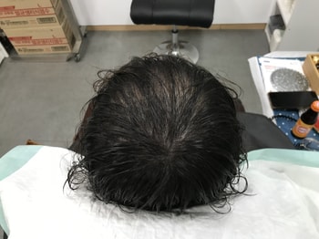 시술 후