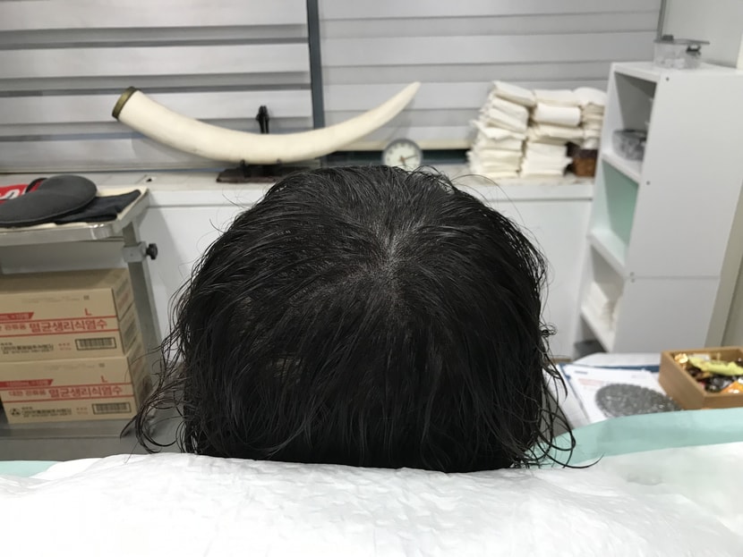 시술 후
