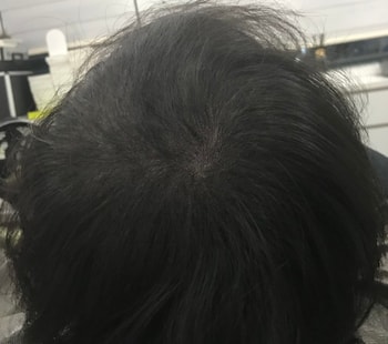 리터치후