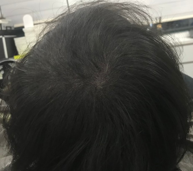 리터치후