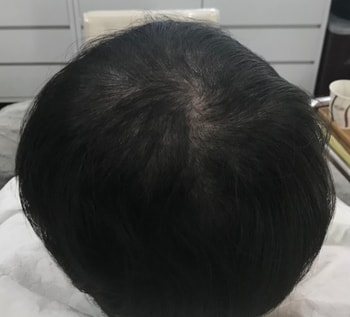 리터치전