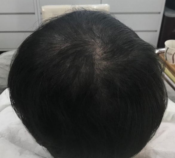 리터치전