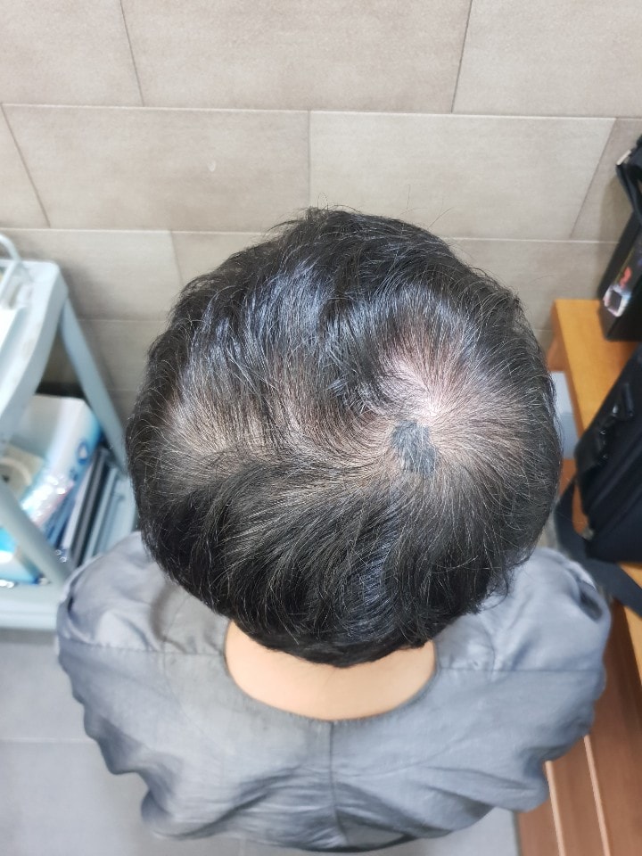 这是NHI新发型头皮纹身后期。