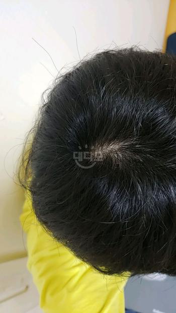 정수리 시술 전