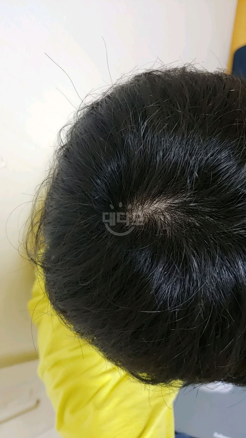 강남미켈란 후두부흉터 헤어라인 교정 2차시술 후기 올려봅니다