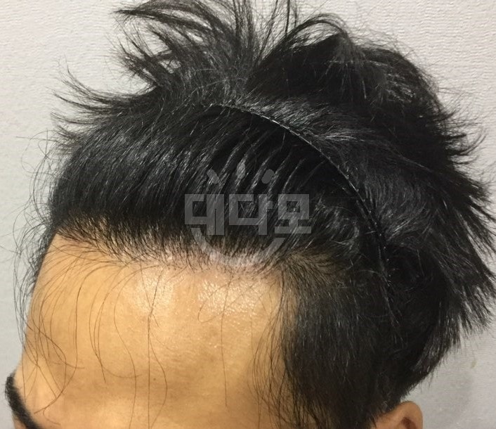이마 이식부위 시술 전