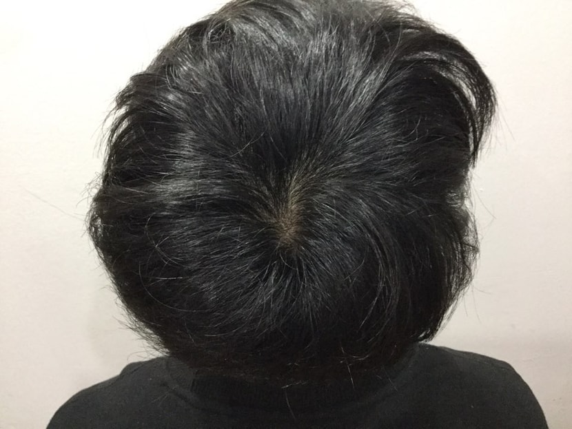 정수리 1차시술 한달반 경과