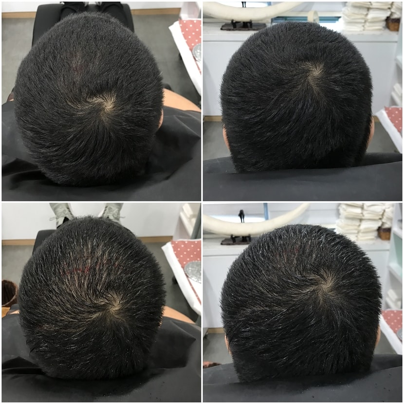 시술전