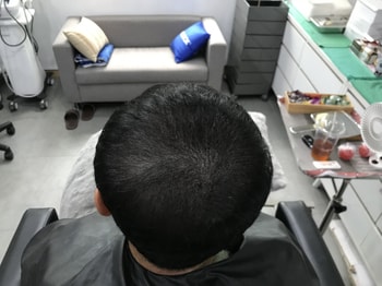 시술후 사진입니다