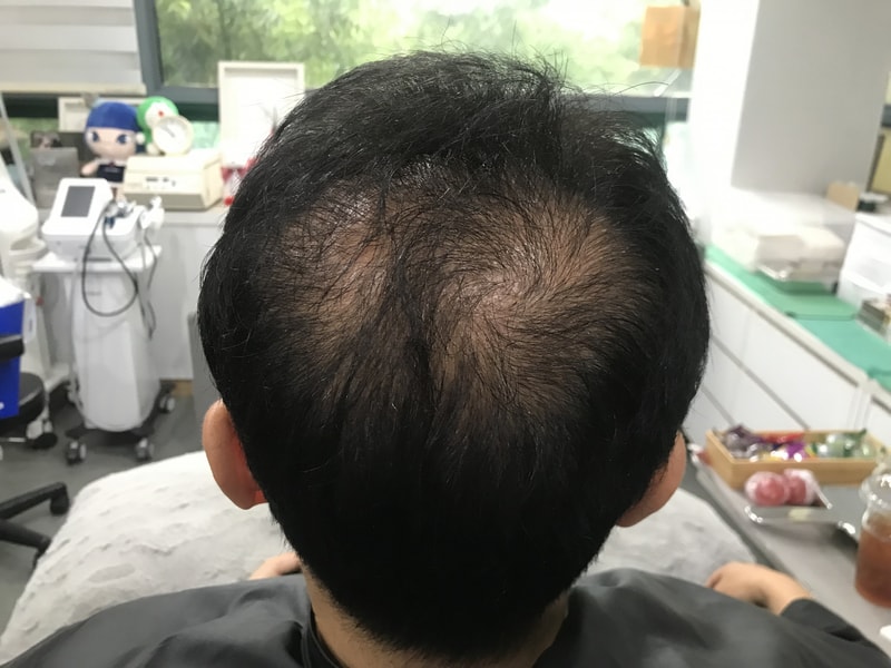 정수리 두피문신 1회차 후기