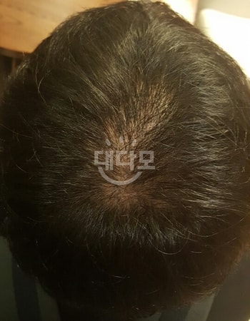 시술 전에 머리상태