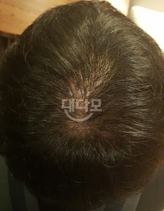 시술 전에 머리상태