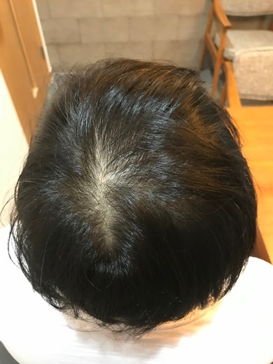 这是头皮纹身后记