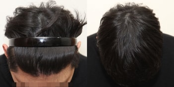 최종경과체크 때 사진