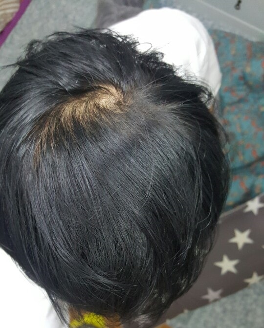 头顶后脑勺疤痕 SMP后记~