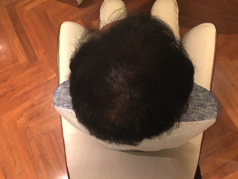 头皮纹身十天后记