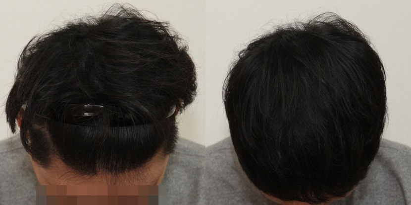 리터치한 뒤 중간체크 때 사진