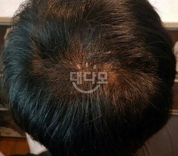 시술 이틀 후쯤 상태