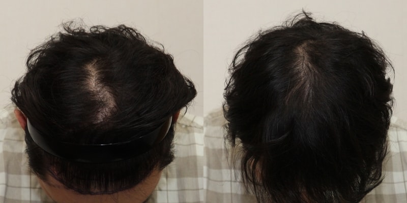 头顶头皮纹身1年半后期呵呵（毛发移植时一起做了）