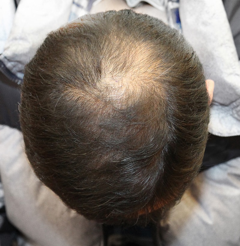 3개월째! 두피문신후기입니다.