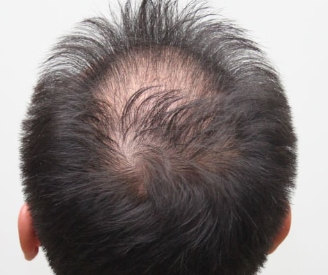 纹头皮已经超过一年半了