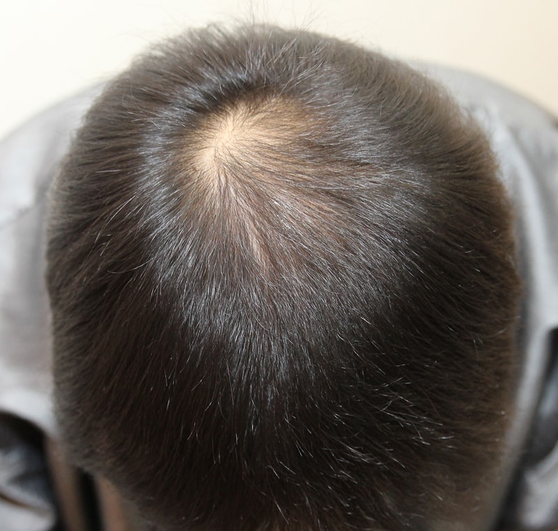 头皮纹身快3周了！ 留下后记吧