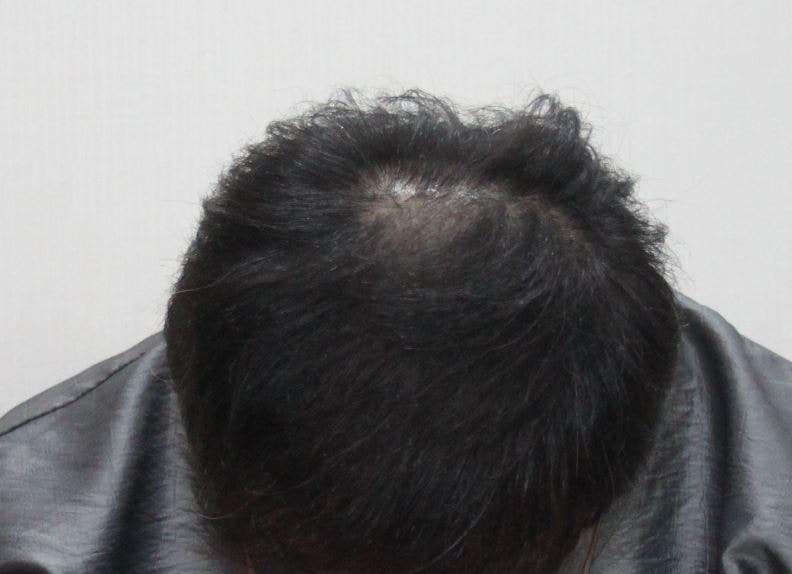 두피문신 받고 1달만에..