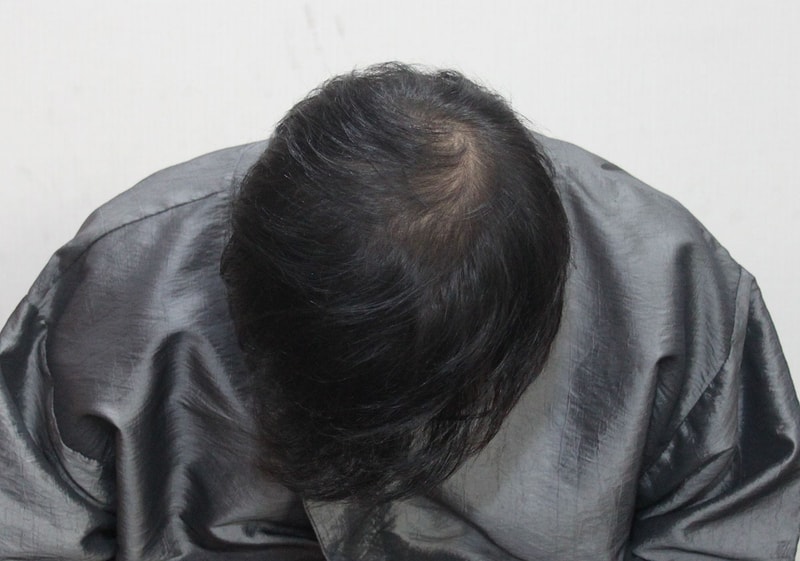 모발이식한지 이년후 두피문신으로 탈모 마무으리! 후기